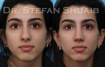 female patient before and after rhinoplasty