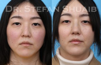 female patient before and after rhinoplasty