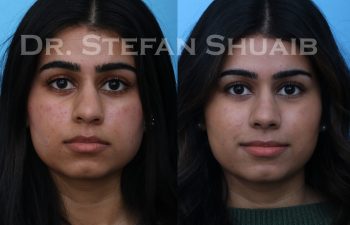 female patient before and after rhinoplasty procedure