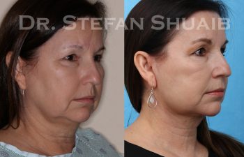 female patient before and after facial rejuvenation