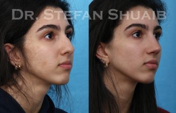 female patient before and after rhinoplasty