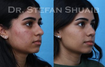 female patient before and after rhinoplasty procedure