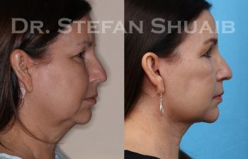 female patient before and after facial rejuvenation