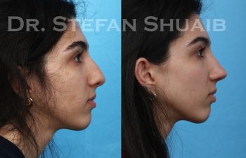 female patient before and after rhinoplasty