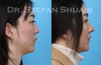 female patient before and after rhinoplasty