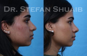 female patient before and after rhinoplasty procedure