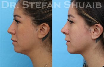 female patient before and after rhinoplasty