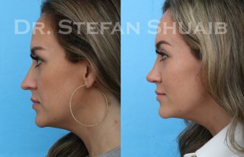 rhinoplasty before and after photo