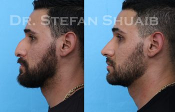 male patient before and after rhinoplasty