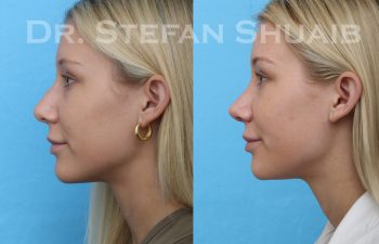 female patient before and after rhinoplasty procedure