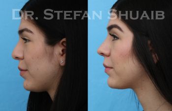 female patient before and after rhinoplasty procedure