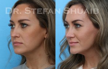 rhinoplasty before and after photo