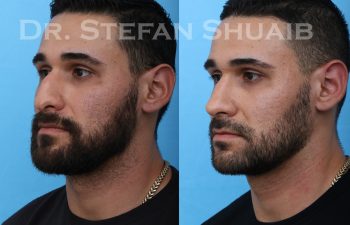 male patient before and after rhinoplasty