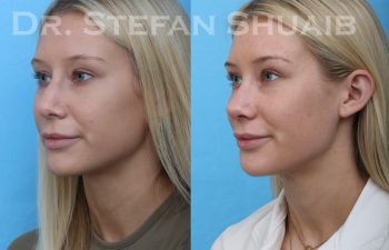 female patient before and after rhinoplasty procedure