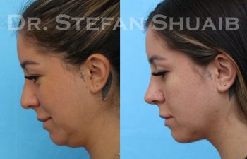 female patient before and after neck lift procedure