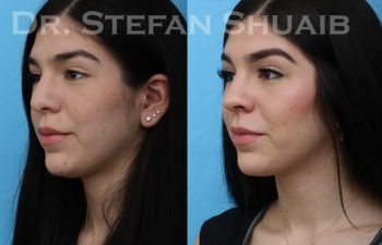 female patient before and after rhinoplasty procedure