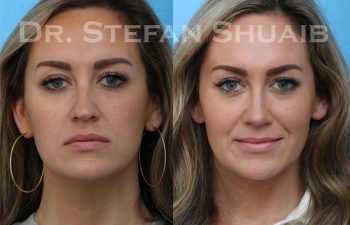 rhinoplasty before and after photo