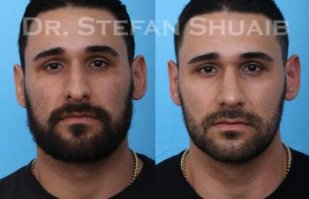 male patient before and after rhinoplasty