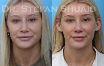 female patient before and after rhinoplasty procedure