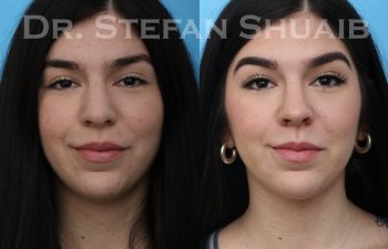 female patient before and after rhinoplasty procedure