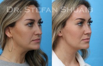 rhinoplasty before and after photo