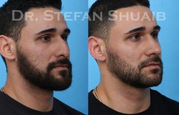 male patient before and after rhinoplasty