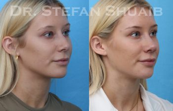 female patient before and after rhinoplasty procedure