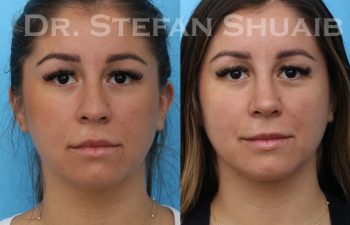 female patient before and after rhinoplasty