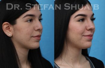 female patient before and after rhinoplasty procedure