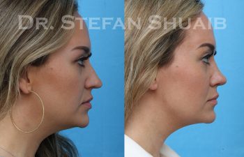 rhinoplasty before and after photo