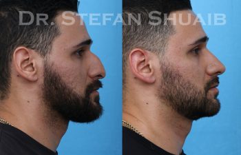 male patient before and after rhinoplasty