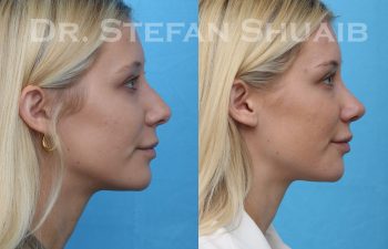 female patient before and after rhinoplasty procedure