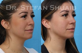 female patient before and after rhinoplasty