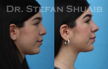 female patient before and after rhinoplasty procedure