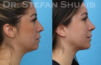 female patient before and after rhinoplasty