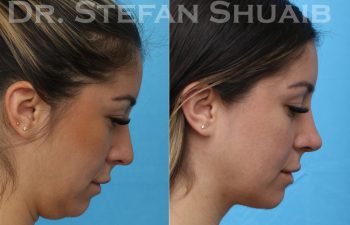 female patient before and after neck lift procedure