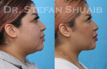 female patient before and after neck lift procedure