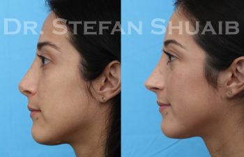 female patient before and after revision rhinoplasty procedure