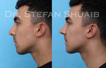 male patient before and after revision rhinoplasty procedure