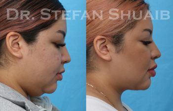 female patient before and after neck lift procedure