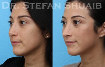 female patient before and after revision rhinoplasty procedure