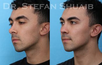male patient before and after revision rhinoplasty procedure
