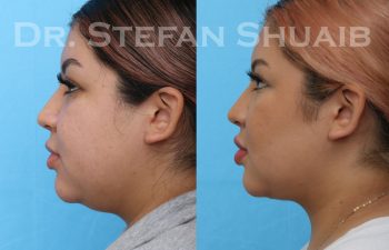 female patient before and after neck lift procedure