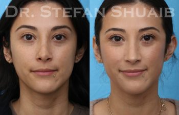 female patient before and after revision rhinoplasty procedure