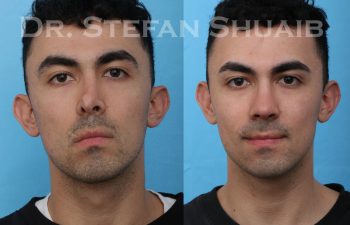 male patient before and after revision rhinoplasty procedure