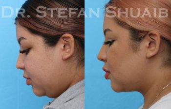 female patient before and after neck lift procedure