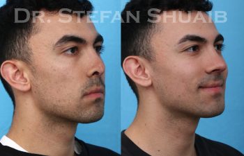 male patient before and after revision rhinoplasty procedure