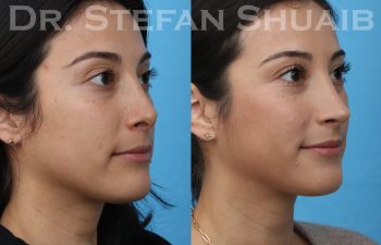 female patient before and after revision rhinoplasty procedure