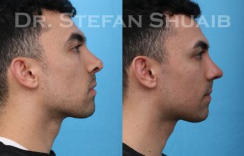 male patient before and after revision rhinoplasty procedure