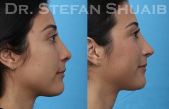 female patient before and after revision rhinoplasty procedure